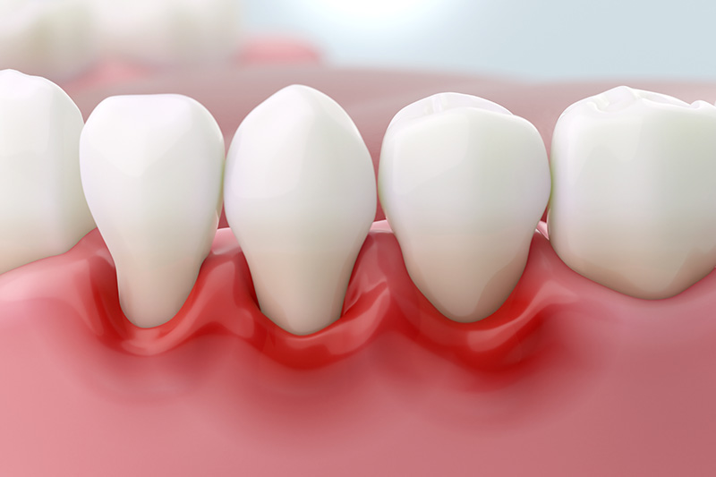 Periodontics Treatment in Oradell