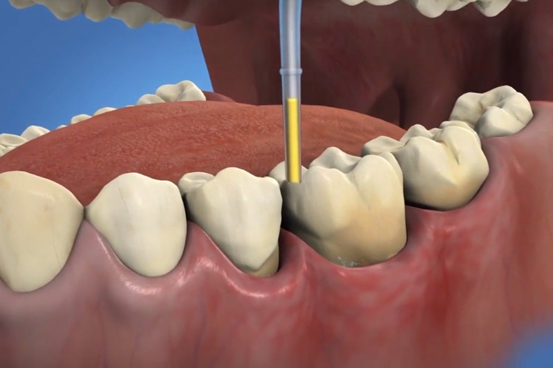 Periodontics Treatment with Arestin in Oradell